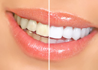 Professional Teeth Whitening Services In Alexandria VA